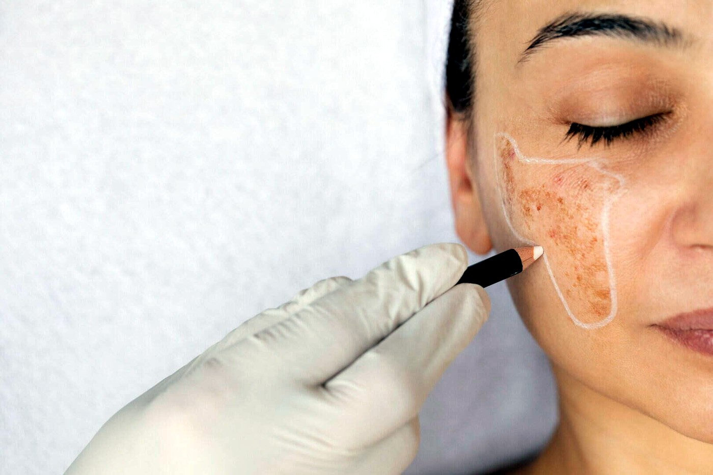 Close-up skin planning image illustrating a pigmentation support journey